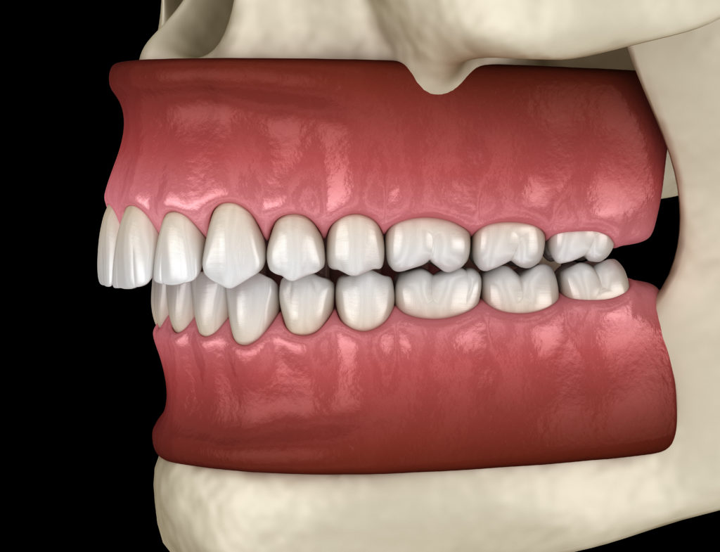 Case Study on Chipped Lower Teeth in Manchester, MO