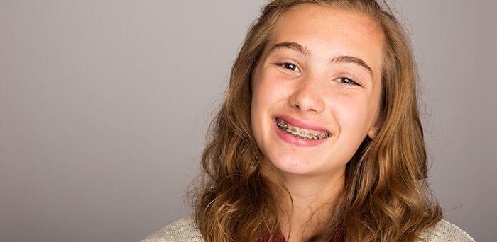 What are Dental Braces?