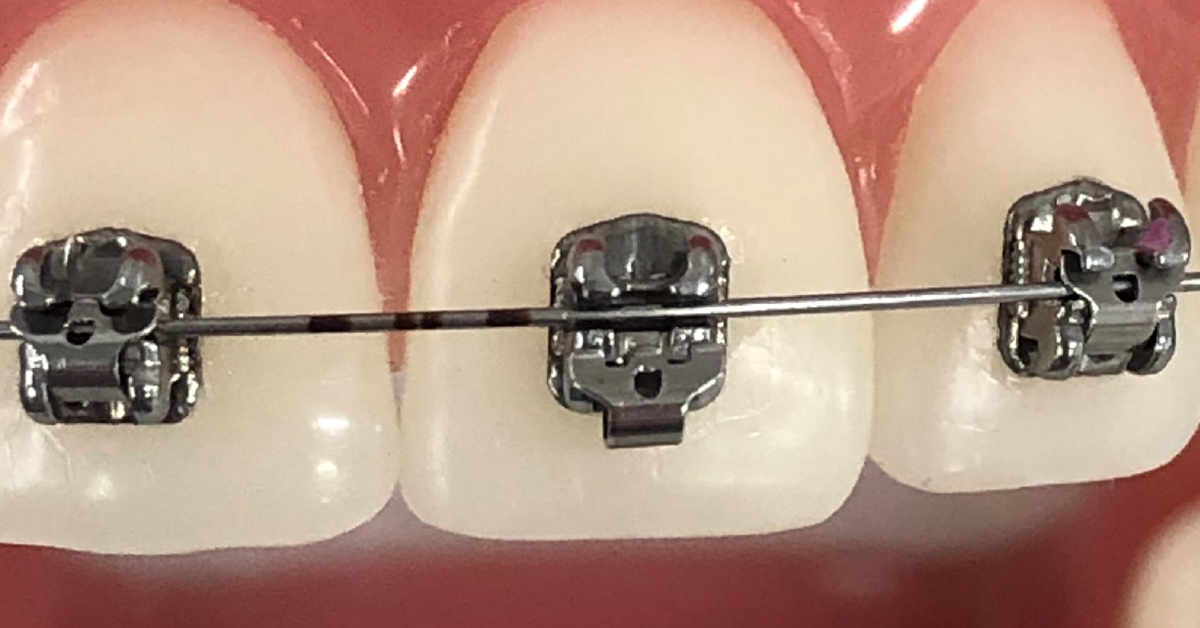 closeup image of brackets used for braces on teeth