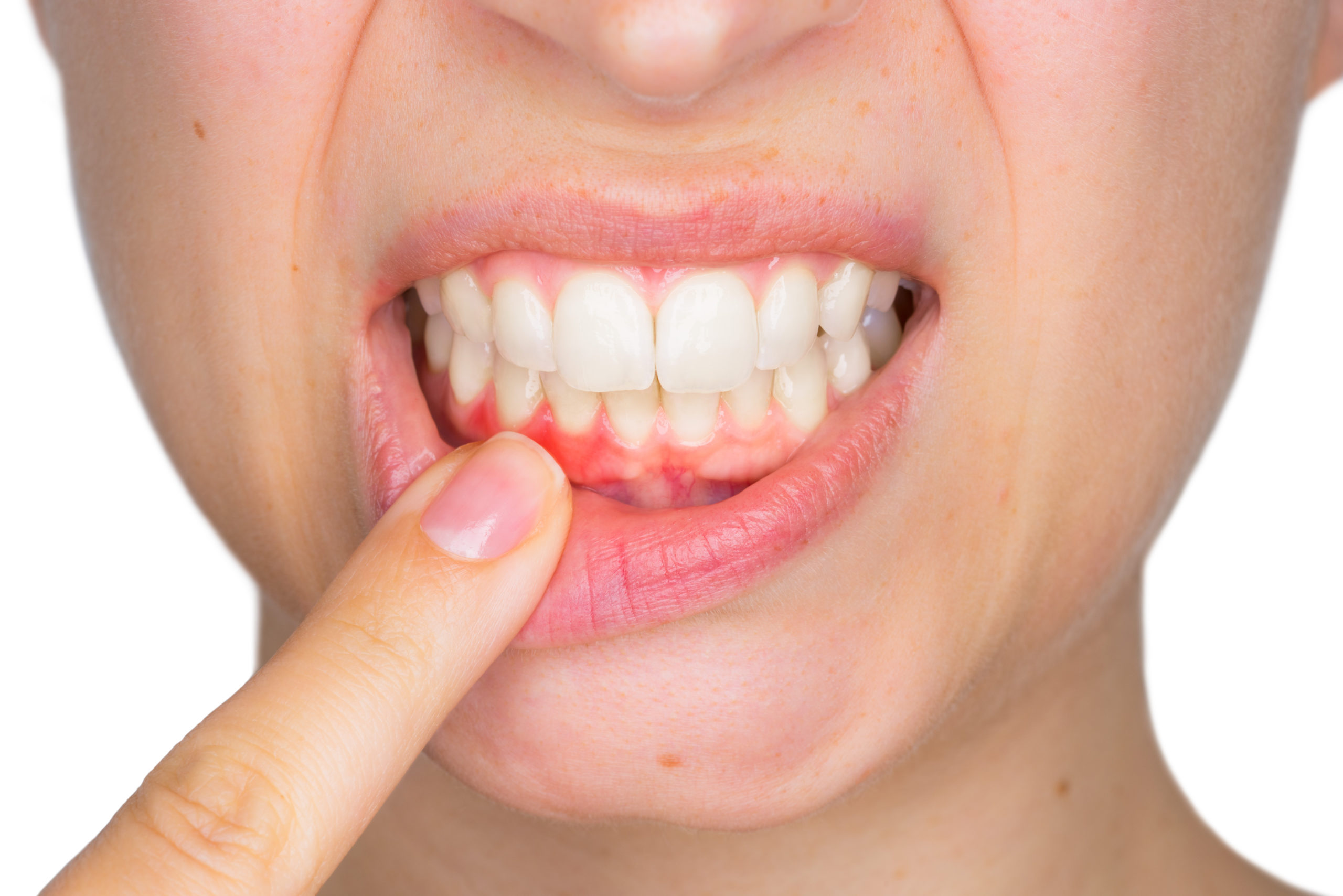 photo of irritated gums and gum disease